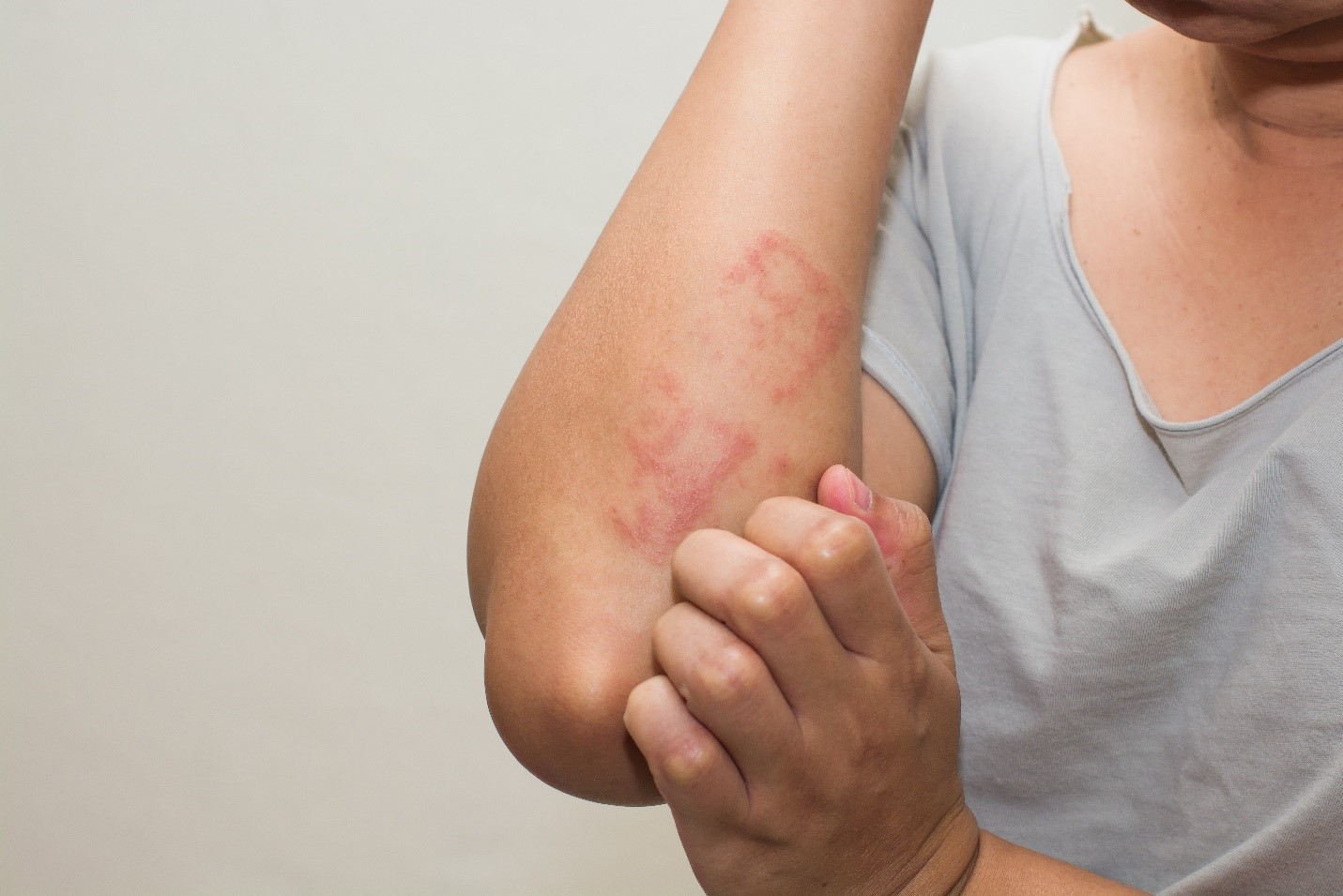 Urticaria-Hives